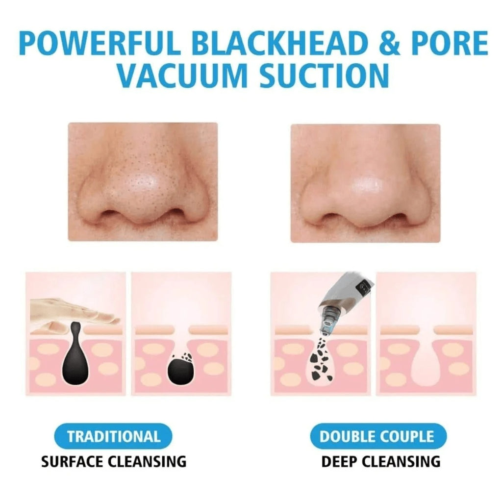 Electric Blackhead Vacuum Remover